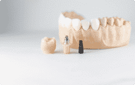 Georgetown Dental Implants