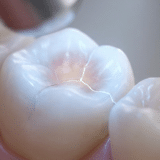 Broken Tooth